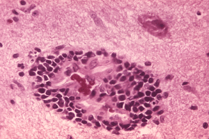 Rabies encephalitis PHIL 3368